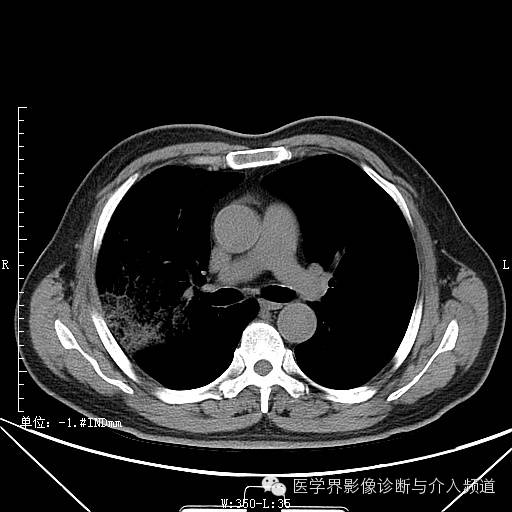 【病例】右肺上叶腺癌1例CT影像表现