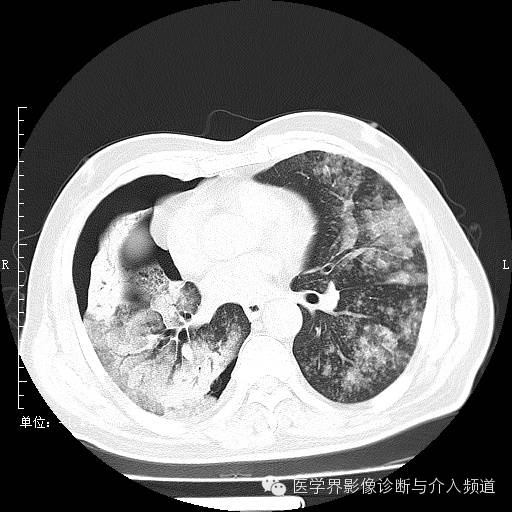 【病例】右肺上叶腺癌1例CT影像表现