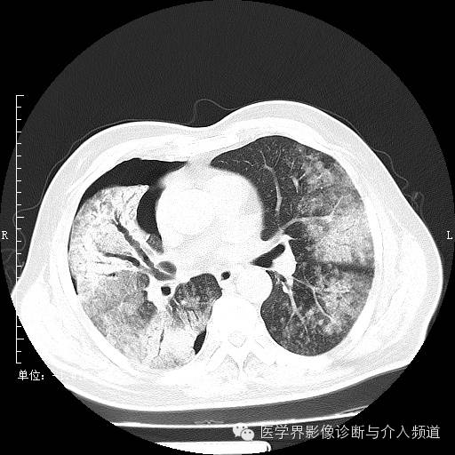 【病例】右肺上叶腺癌1例CT影像表现