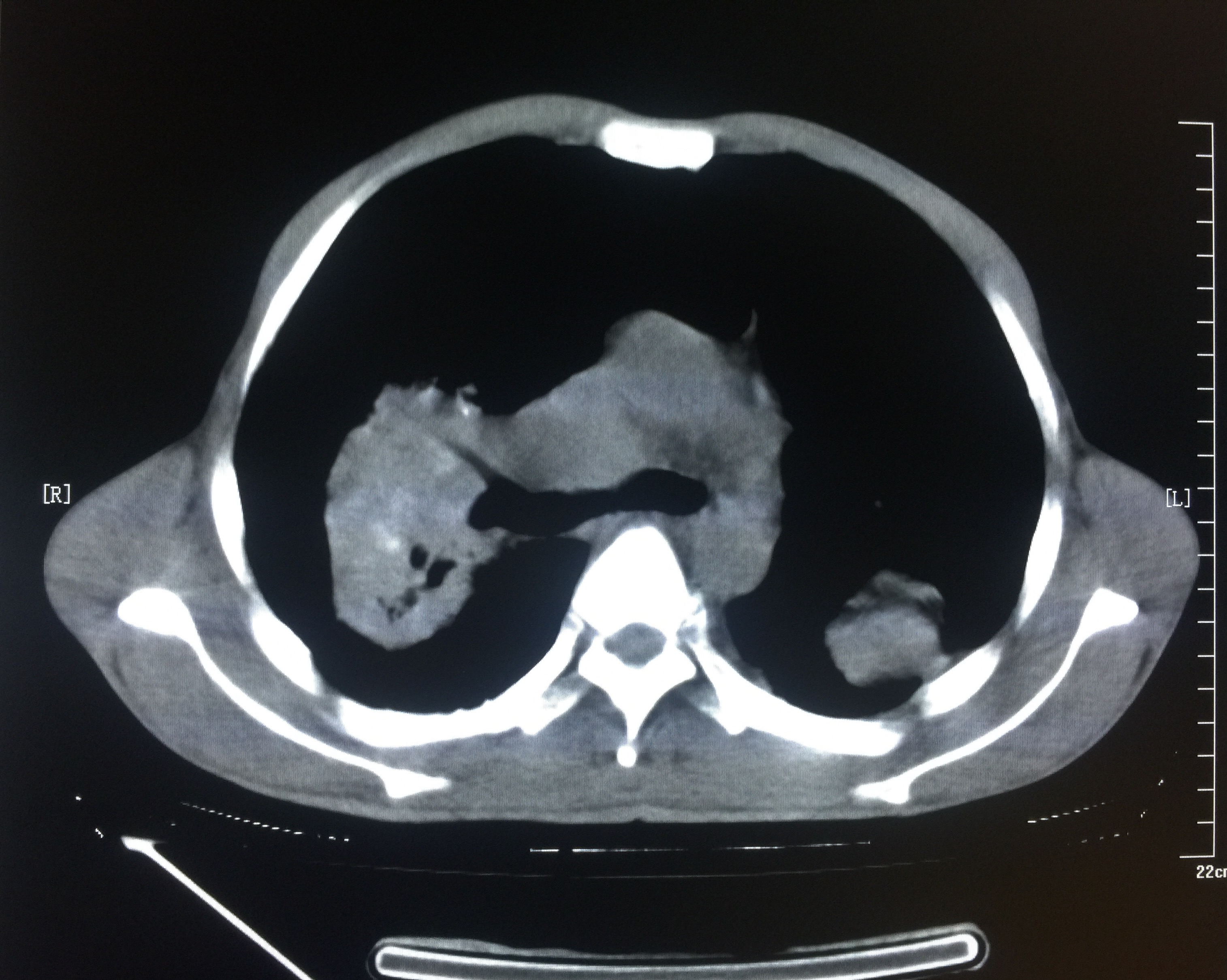 【病例】矽肺1例CT影像表现