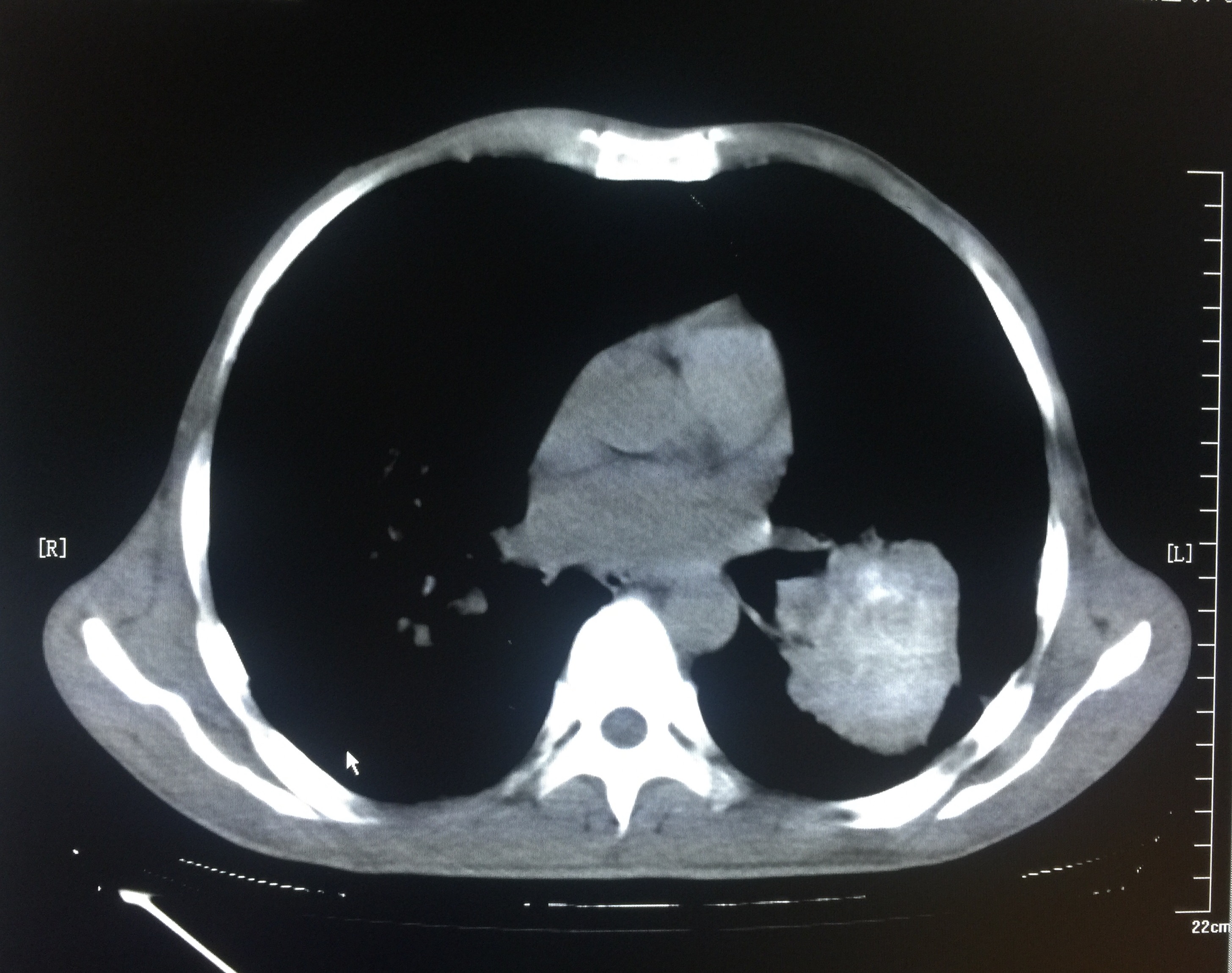 【病例】矽肺1例CT影像表现