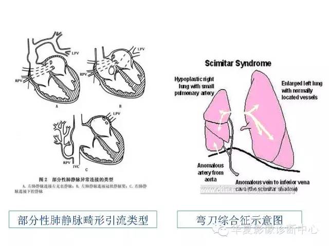 【PPT】弯刀综合征