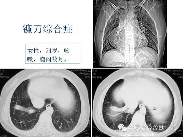 【PPT】弯刀综合征