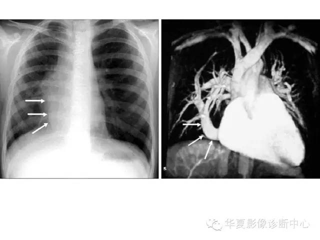 【PPT】弯刀综合征