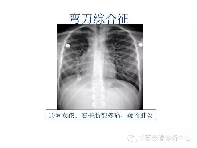 【PPT】弯刀综合征