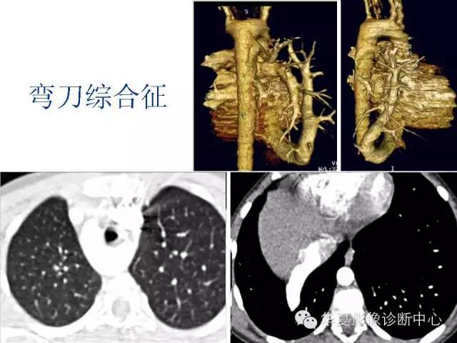 【PPT】弯刀综合征