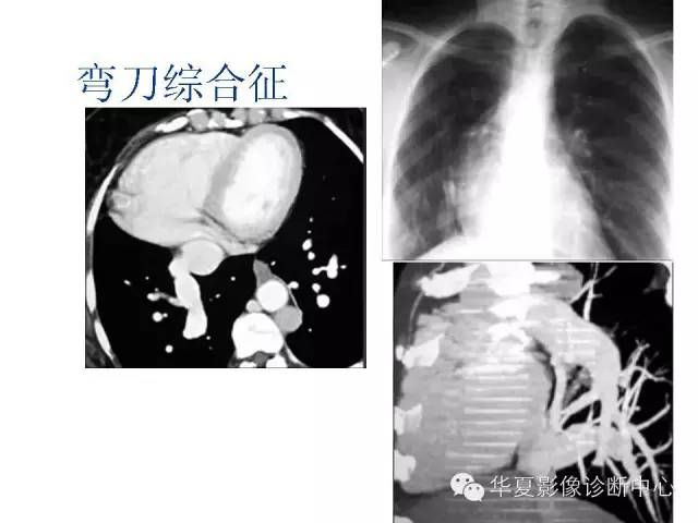 【PPT】弯刀综合征