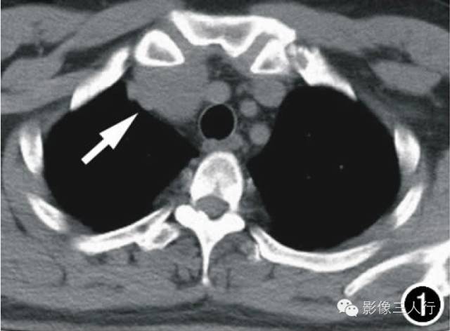 【病例】前纵隔孤立性纤维瘤1例