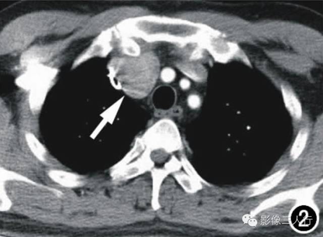 【病例】前纵隔孤立性纤维瘤1例