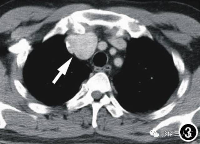 【病例】前纵隔孤立性纤维瘤1例