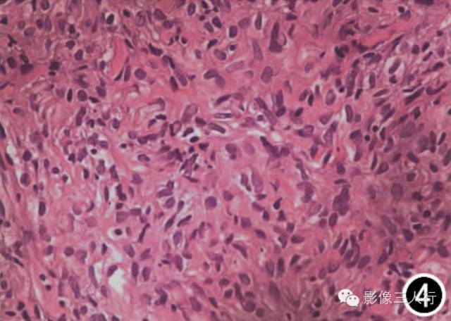 【病例】前纵隔孤立性纤维瘤1例