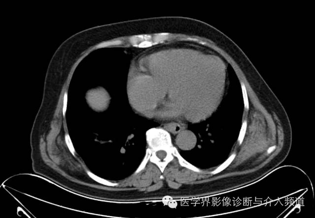 【病例】胸壁弹力纤维瘤1例CT影像表现