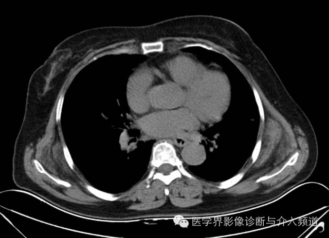 【病例】胸壁弹力纤维瘤1例CT影像表现