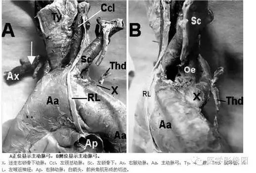 迷走右锁骨下动脉