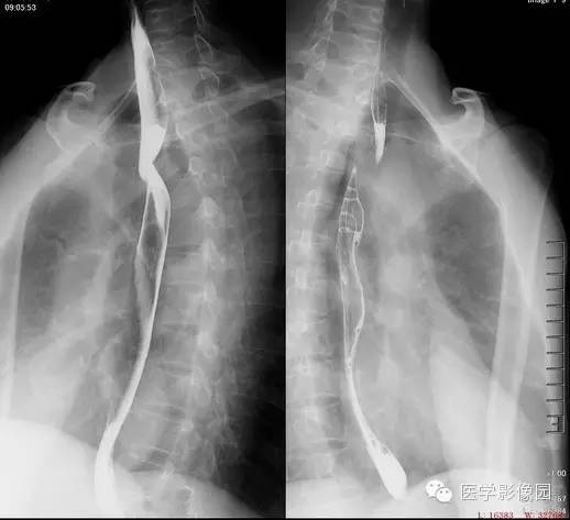 迷走右锁骨下动脉