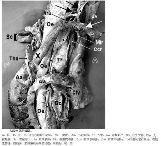 迷走右锁骨下动脉
