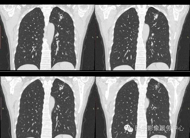 【病例】肺曲菌病1例CT影像表现
