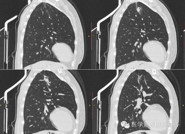 【病例】肺曲菌病1例CT影像表现