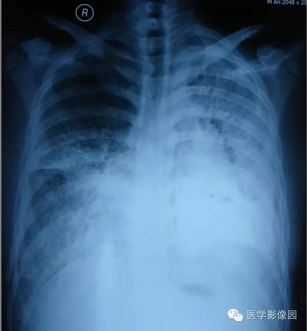 【病例】尘肺1例X线及CT影像表现