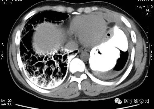 【病例】尘肺1例X线及CT影像表现