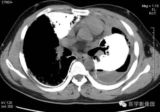 【病例】尘肺1例X线及CT影像表现
