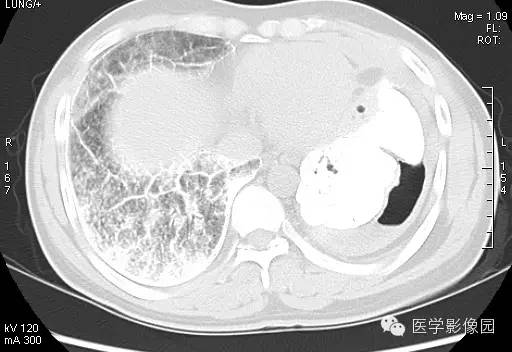 【病例】尘肺1例X线及CT影像表现