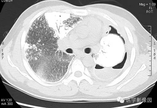 【病例】尘肺1例X线及CT影像表现