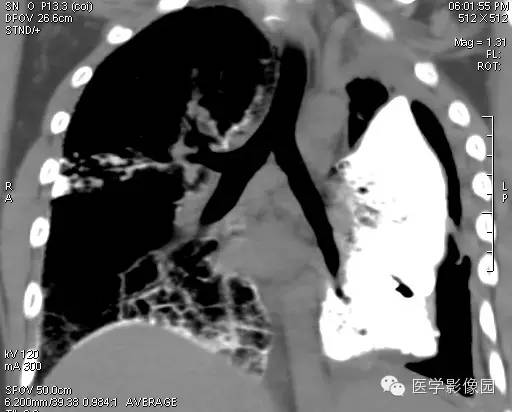 【病例】尘肺1例X线及CT影像表现
