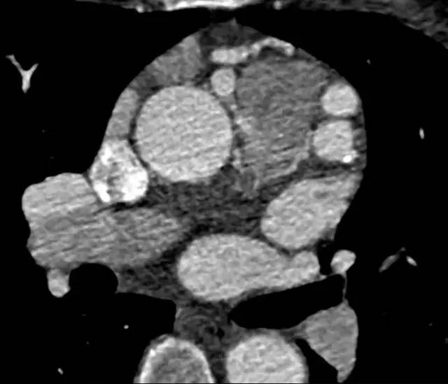 【病例】起源异常的冠状动脉1例CT影像表现