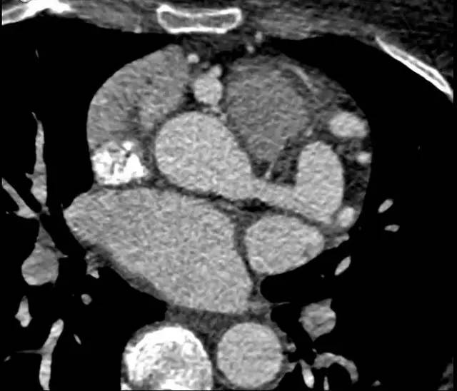 【病例】起源异常的冠状动脉1例CT影像表现