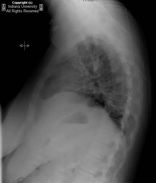 【病例】普通型间质性肺炎/特发性肺间质纤维化1例CT