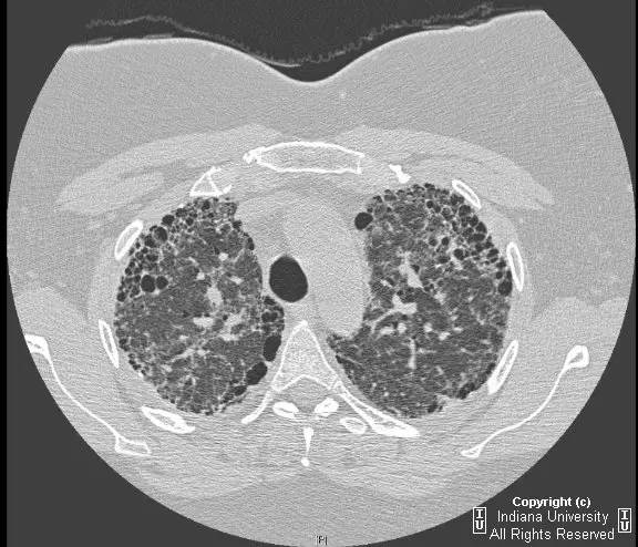 【病例】普通型间质性肺炎/特发性肺间质纤维化1例CT