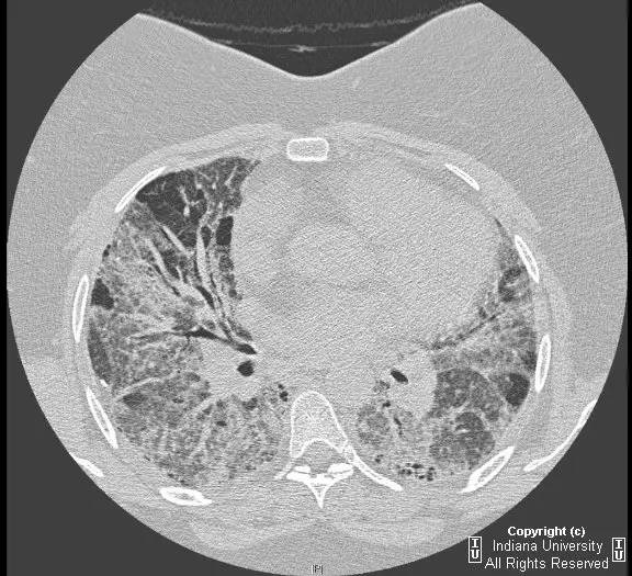 【病例】普通型间质性肺炎/特发性肺间质纤维化1例CT