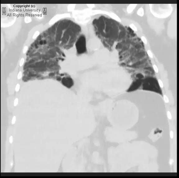 【病例】普通型间质性肺炎/特发性肺间质纤维化1例CT