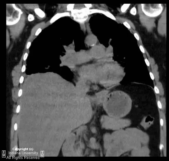 【病例】普通型间质性肺炎/特发性肺间质纤维化1例CT