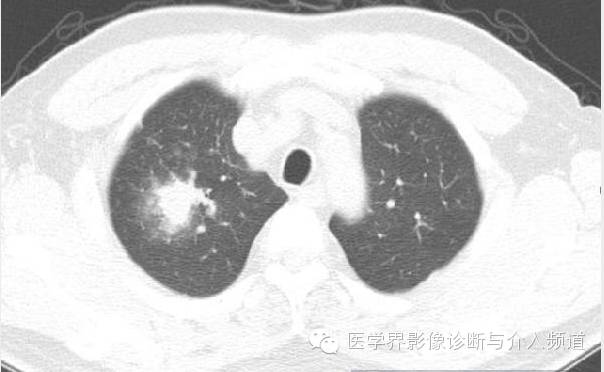 【病例】肺吸虫病1例X线及CT影像表现