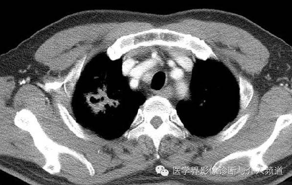 【病例】肺吸虫病1例X线及CT影像表现