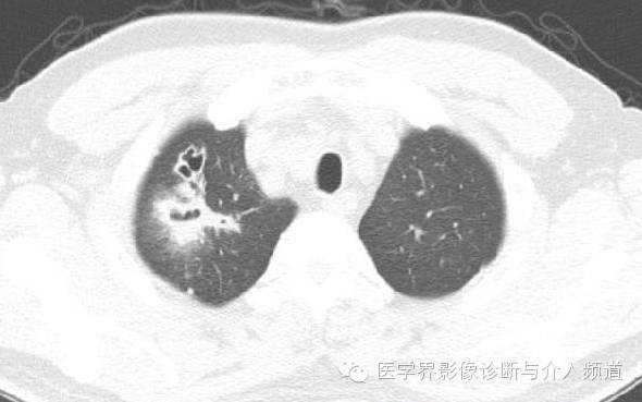 【病例】肺吸虫病1例X线及CT影像表现