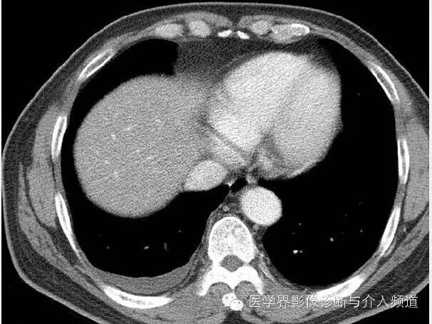 【病例】肺吸虫病1例X线及CT影像表现