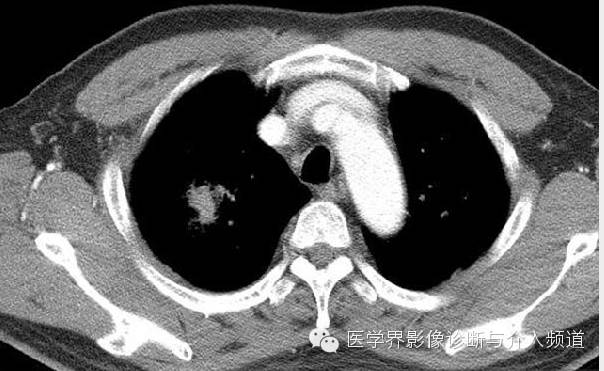 【病例】肺吸虫病1例X线及CT影像表现