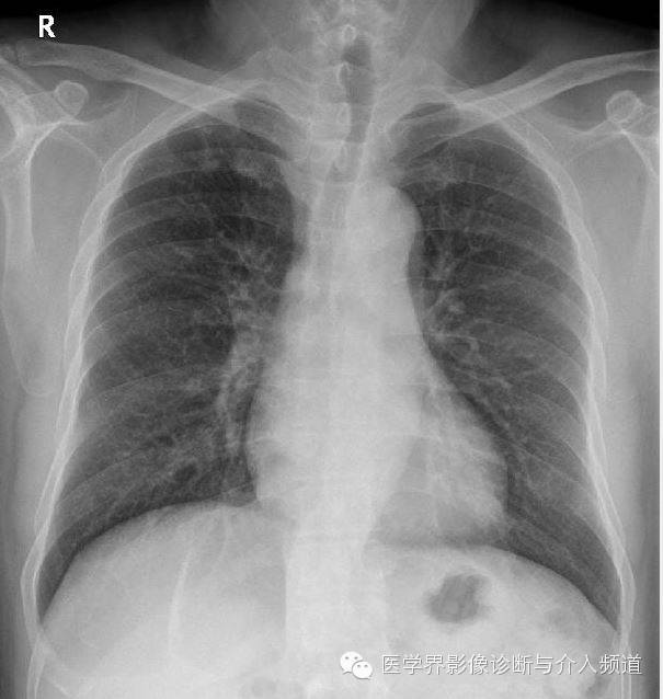 【病例】肺吸虫病1例X线及CT影像表现