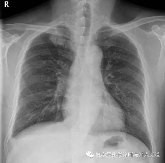 【病例】肺吸虫病1例X线及CT影像表现