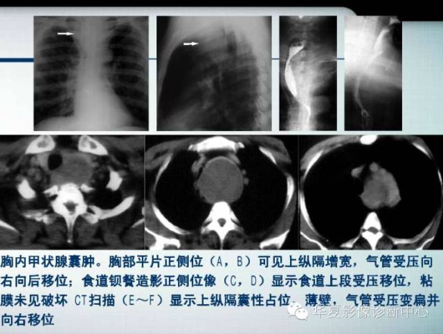 【PPT】纵隔囊肿性病变的影像学诊断