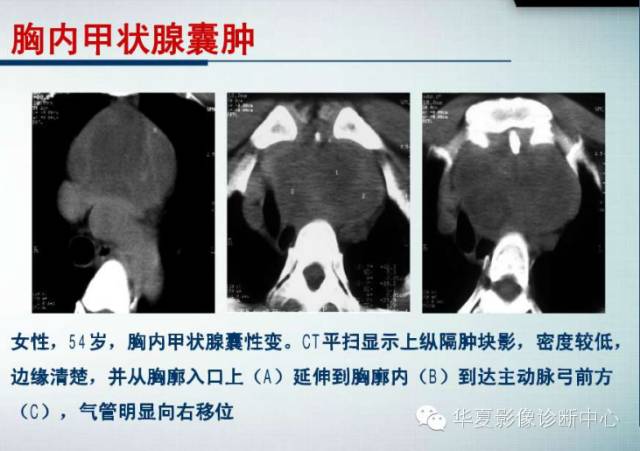 【PPT】纵隔囊肿性病变的影像学诊断