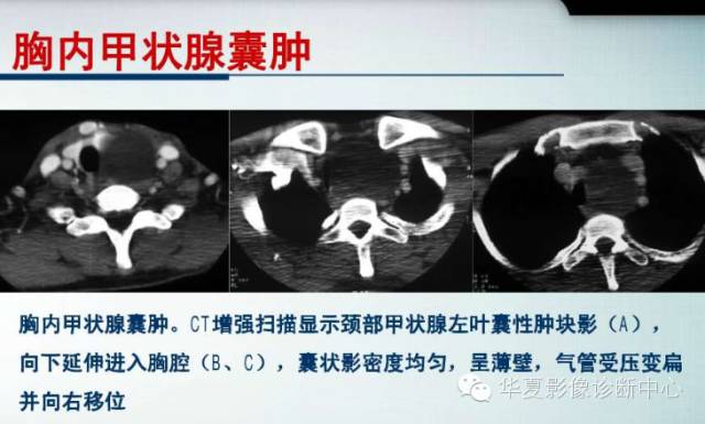 【PPT】纵隔囊肿性病变的影像学诊断