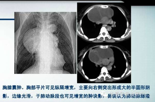 【PPT】纵隔囊肿性病变的影像学诊断