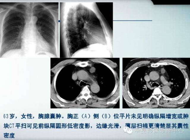 【PPT】纵隔囊肿性病变的影像学诊断