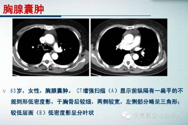 【PPT】纵隔囊肿性病变的影像学诊断