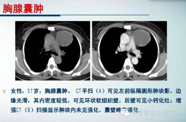 【PPT】纵隔囊肿性病变的影像学诊断