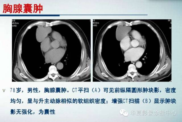 【PPT】纵隔囊肿性病变的影像学诊断